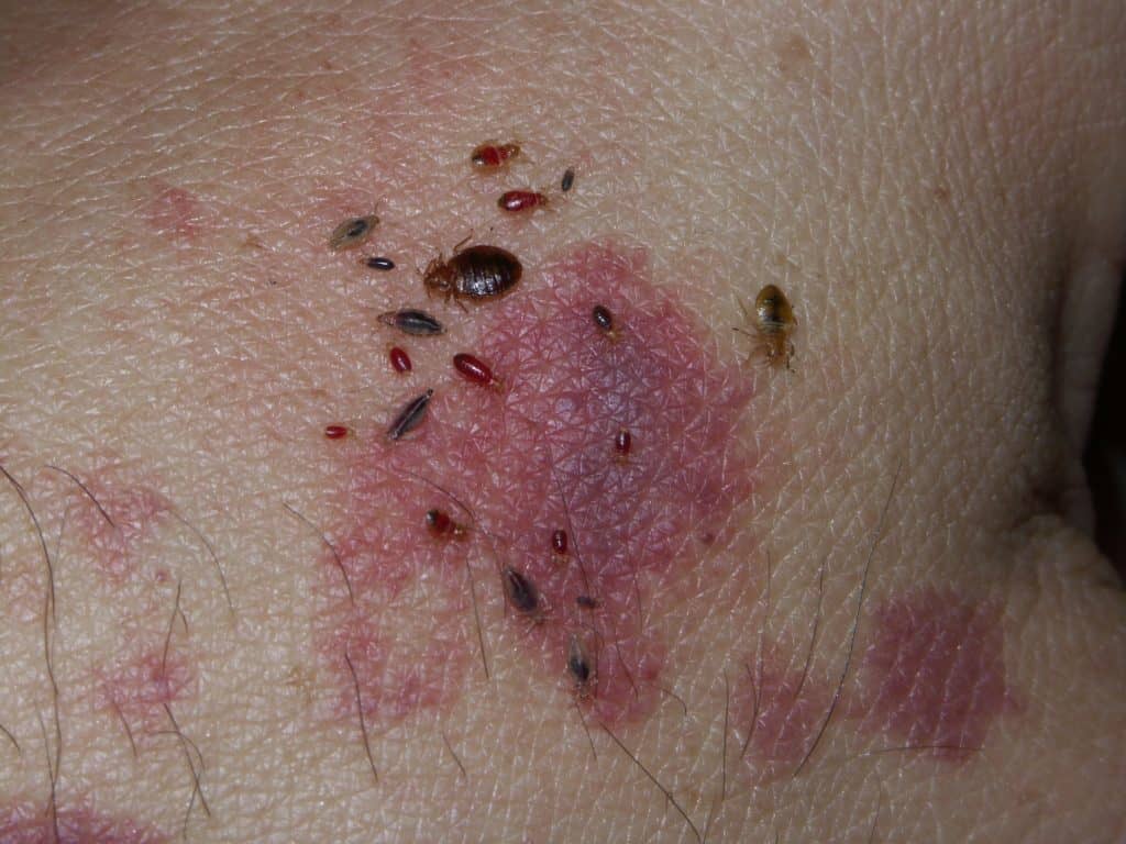 Pictures of Bed Bugs Bites on Real People | Debedbug