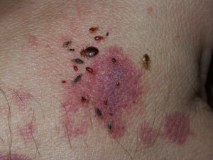 bed bug bite marks on skin