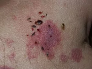  marcas de mordidas de percevejos na pele