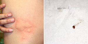 crushed bed bug and bite rash on skin
