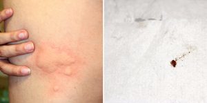 Bed Bug Bite Rash Skin 300x149 