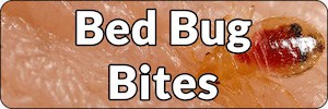 Bed Bug Bites Banner