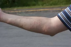  Mușcături de gândaci de pat marchează mușcăturile de pe braț