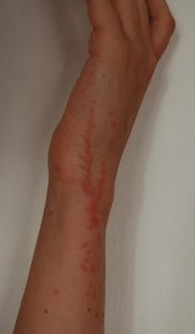 line bed bug bites skin rash