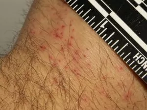 Mușcături de gândaci de pat pe piele