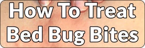 how to treat bed bug bites banner
