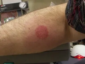 Morso grave di cimice dei letti su braccio con eruzione cutanea