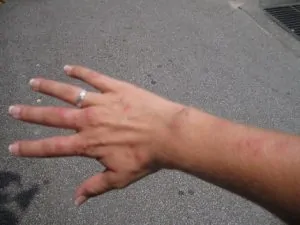 Bedbugsbid på arm og hånd, kraftig reaktion