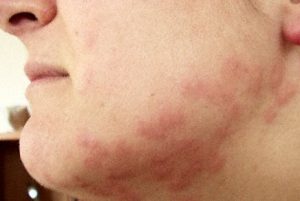 Rashing bed bug bites on face