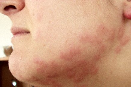 bed bug bites on face and neck