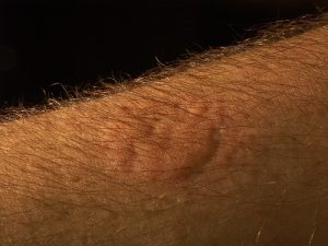 Severe bed bug bite welt on arm