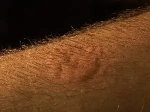 Morso grave di cimice dei letti sul braccio