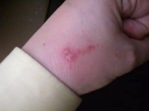 Bed bug bite welts hand after infection