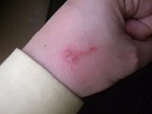 Une main marquée par une piqûre de punaise de lit après infection