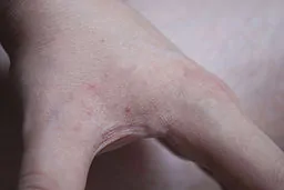 Plusieurs piqûres de punaises de lit sur la main, réaction légère