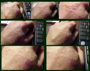 Extreme bed bug bites on hand welting