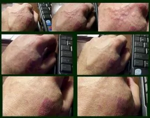  Mușcături extreme de gândaci de pat pe mână cu aspect de welting
