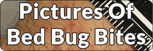 pictures of bed bug bites on people page banner