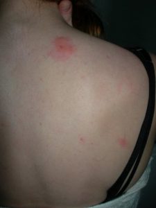 Bed bug bites on shoulder and neck
