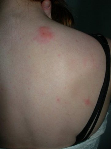 bed bug bites on back