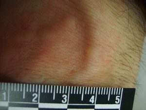 Bed bug bite leg rash measured