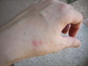 Bed bug bite welts hand before infection