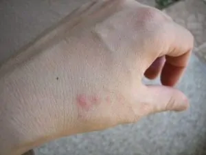 Les zébrures de piqûres de punaises de lit montrent sur la main avant l'infection